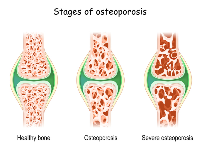 οστεοπόρωση