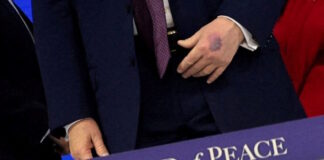 trump bruise r 1200x630.jpg