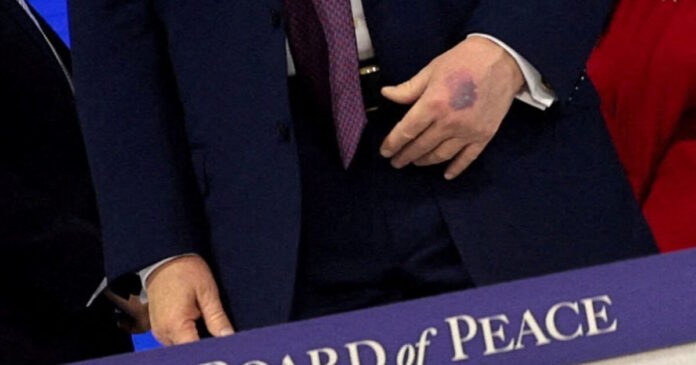 trump bruise r 1200x630.jpg