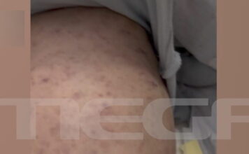 miniggitida vrefos patra 1200x630.jpg