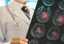 Ανεύρυσμα εγκεφάλου: Ο «σιωπηλός κίνδυνος» που μπορεί να μην δώσει σημάδια egkefalos 1200x630.jpg