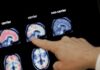 alzheimer 1200x630.jpg