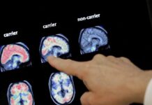 alzheimer 1200x630.jpg