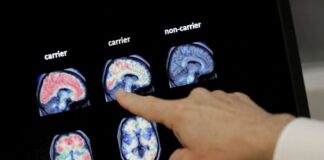alzheimer 1200x630.jpg