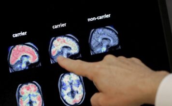 alzheimer 1200x630.jpg